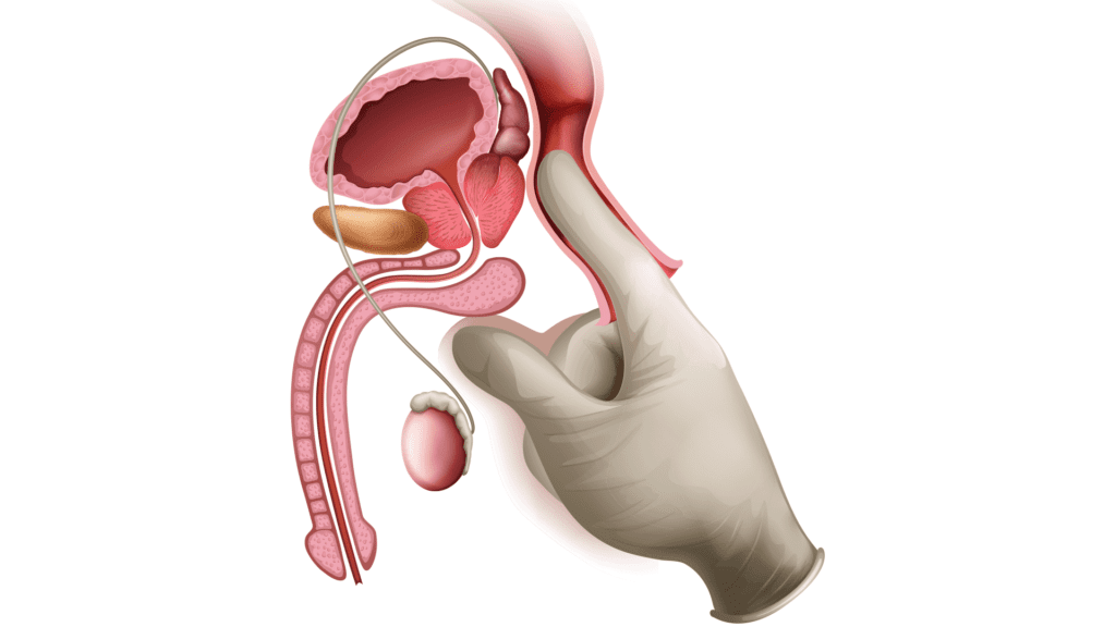 Imagem ilustrativa do exame de toque retal para detectar câncer de próstata