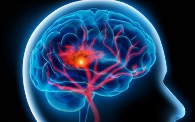 AVC: O que é Acidente Vascular Cerebral e quais os sintomas?